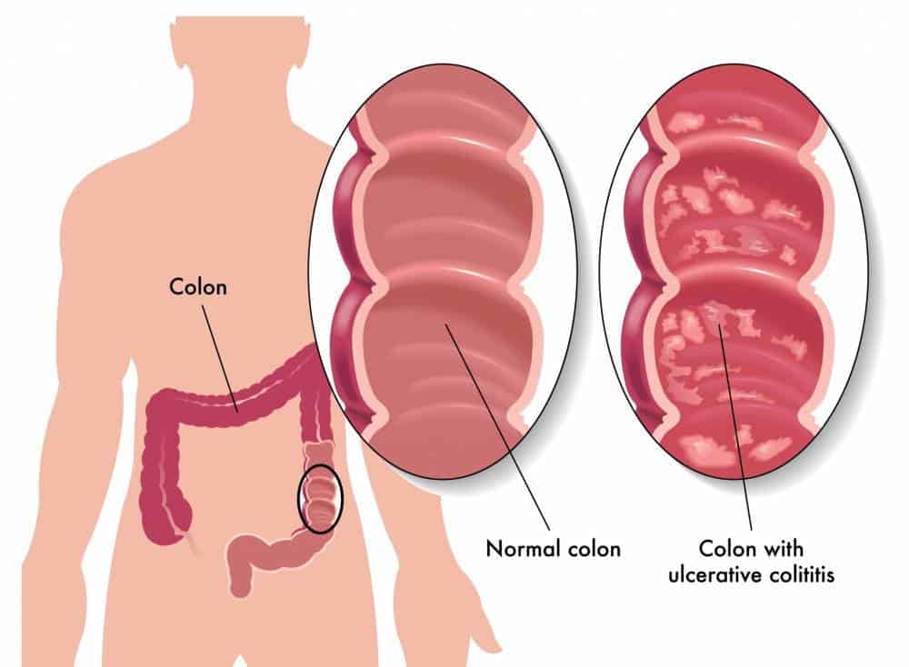 Un gráfico de comparación entre un colon normal y un colon infectado con Colitis Ulcerativa.